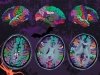 «Изнанка» депрессии – нейродегенерация «Изнанка» депрессии – нейродегенерация