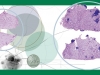 Nucleases against Metastases Nucleases against Metastases
