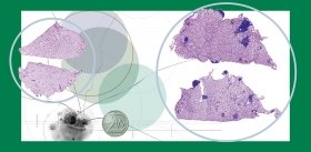 Nucleases against Metastases